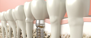 Implantes dentales Estoclinic Terrassa