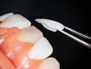 Carillas dentales Estoclinic Terrassa