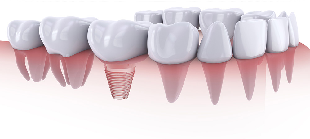 Qué son los implantes dentales ESTOCLINIC Clínica dental Terrassa