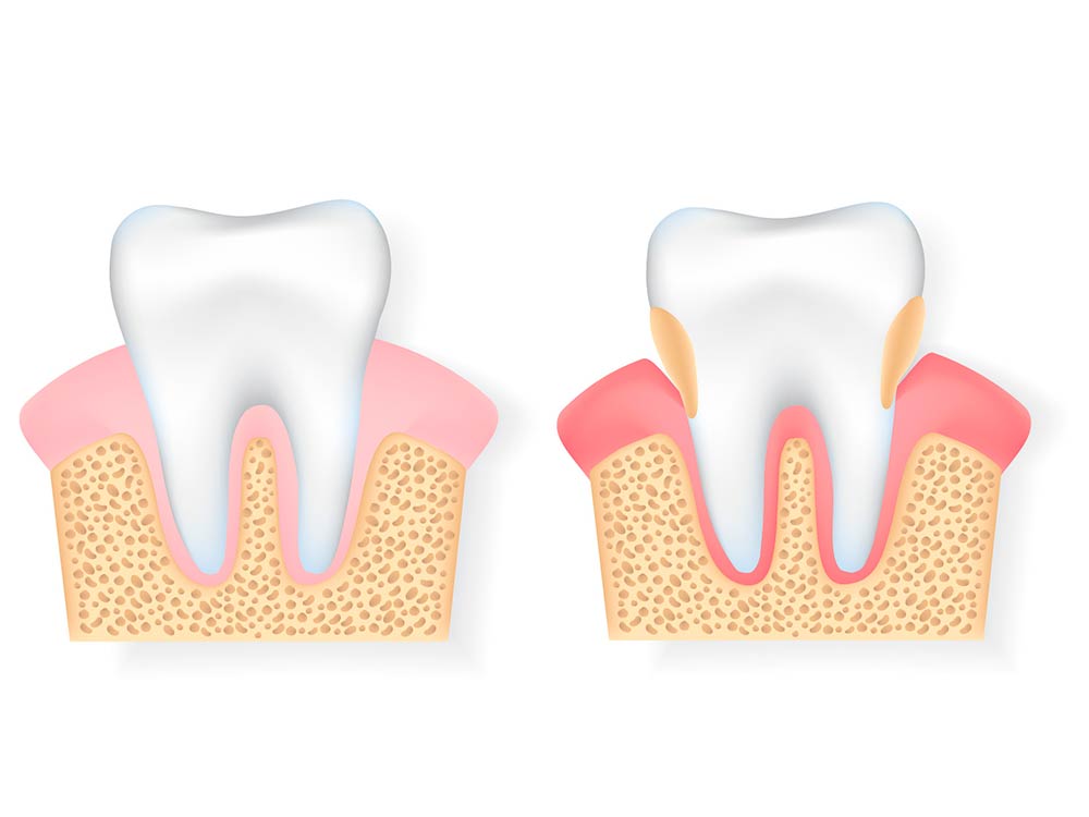 Estado de los dientes con periodontitis