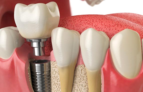 Prótesis dentales ESTOCLINIC Clínica dental Terrassa