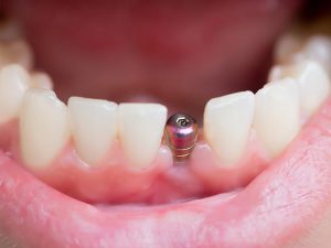 Motivos por los que ponerse implantes dentales