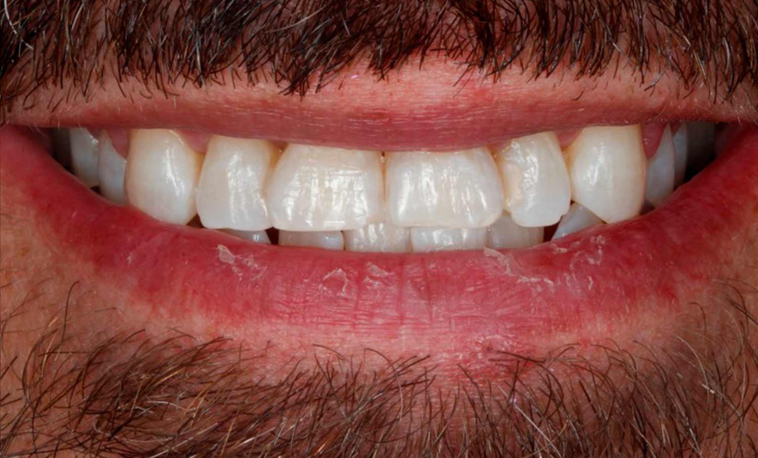 Resultado del blanqueamiento dental