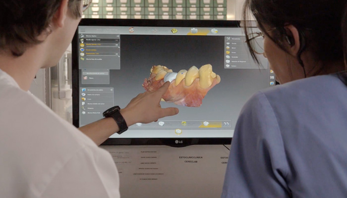Tecnología CAD/CAM para conseguir restauraciones dentales naturales e inmediatas