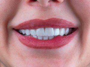 Carillas dentales. ESTOCLINIC Clínica Dental Terrassa
