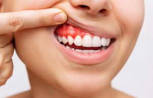 Disciplina esencia Contable Qué es una bolsa periodontal? | Estoclinic en Terrassa