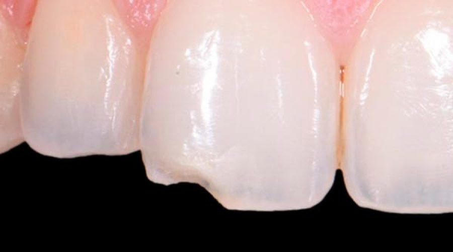Estética dental. ESTOCLINIC Clínica Dental Terrassa
